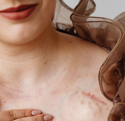 5 Simple Ways to Make Your Scars Less Visible - Number 3 Will Shock You!