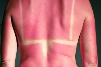 Magical Way to Heal a Sunburn Fast and Restore Your Skin