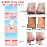 Voibella Pore Vacuum Blackhead Remover